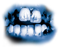 Die toxischen Bestandteile von Meth führen zu massivem Zahnverfall, was auch als „Meth-Zähne“ bekannt ist. Die Zähne verfärben sich, werden schwarz und verfaulen bis zu einem Punkt, wo sie gezogen werden müssen. Zähne und Zahnfleisch werden von innen heraus zerstört und die Zahnwurzeln verfaulen.
